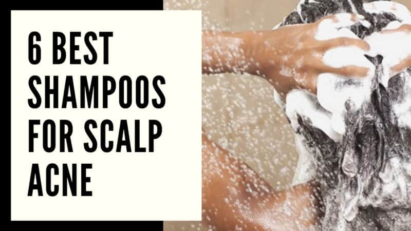 Best Shampoos for Scalp Acne: Get Rid of It Now!
