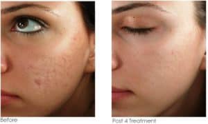 microneedling aftercare