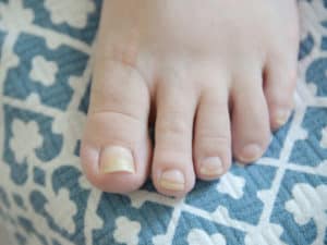 How To Get Rid Of Thick Toenails?