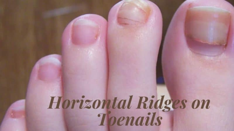 What Causes Horizontal Ridges on Toenails?