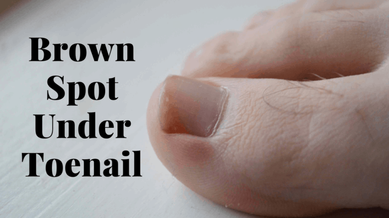 How to Get Rid of Brown Spots Under Toenails?